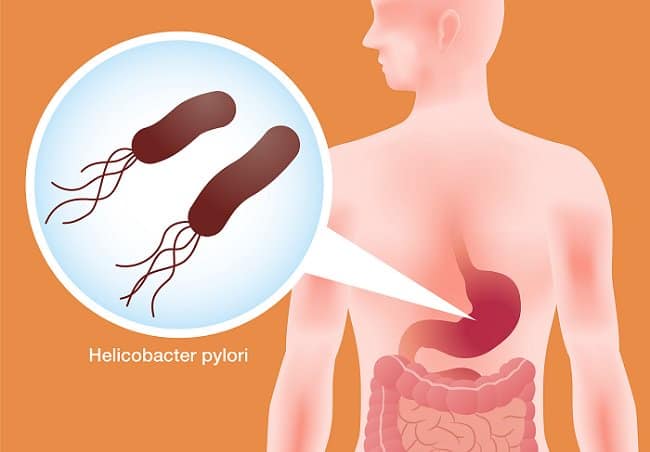 Helicobacter Pylori Co To Jest Objawy Diagnostyka Leczenie Zielarz Dietetykpl 7655
